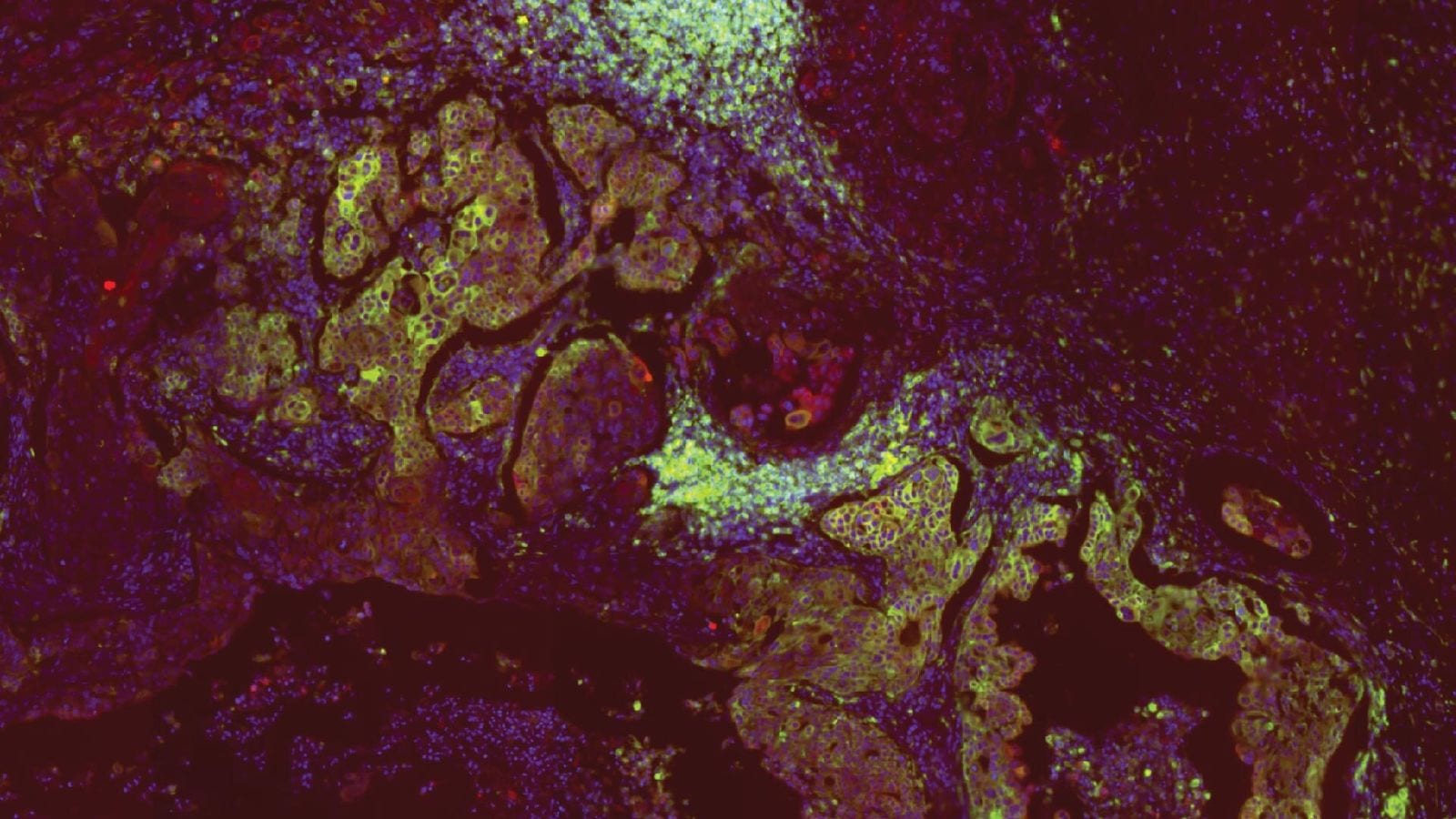 CRISPR Therapy Tested in Children Ages 5–11